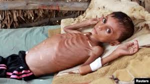 See more ideas about kids boys, kids, boys. Yemeni Boy Fights Malnutrition As Famine Strikes Nation