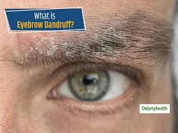 ever heard of eyebrow dandruff know