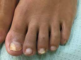 nail fungus symptoms causes and