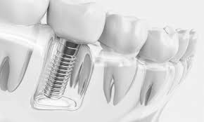 2021 أسعار زراعة الأسنان | Dr. Bayer Clinics