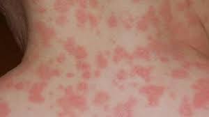malar rash causes symptoms treatment