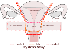 Pain medications, narcotics in particular, can also reduce libido. Hysterectomy Wikipedia