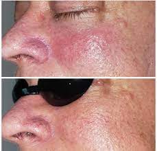 ipl treatment for rosacea in brooklyn