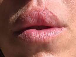 use hyaluronidase on lip scar tissue