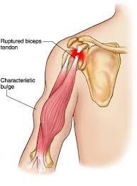 biceps tendon rupture gregory