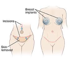 Tummy Tuck with Breast Implants