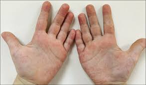 This is a skin condition, which tends to be localized— because it shows up only in the hand and the palms. Indian Journal Of Dermatology Venereology And Leprology A Case Series And Literature Review Of Erythema Palmare Hereditarium Lane S Disease