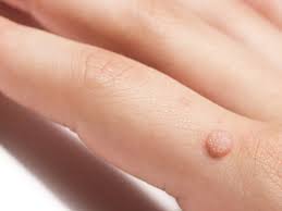 4 common warts and how they re treated