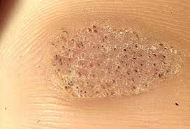 Plantar warts, like all warts, are created by an infection of hpv that enters the skin through a crack, wound or scrape. Plantar Warts Picture Image On Medicinenet Com