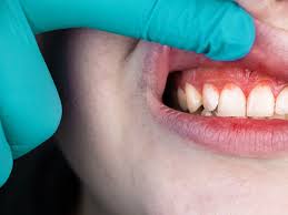 home remes for swollen gums
