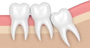Choosing to remove your wisdom teeth later in life can make the extraction more difficult and increase the cost of the wisdom tooth removal. Atlanta Ga Wisdom Teeth Removal Fulton Tooth Extraction Surgery