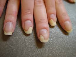 4 nail disorders flashcards quizlet