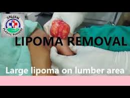 lipoma treatment lipoma surgery in