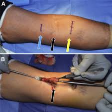 distal biceps tendon rupture