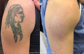 why laser tattoo removal treatments are