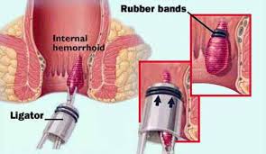 hemorrhoids and fistulas dekalb