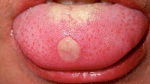 tongue ps 8 causes when to see a