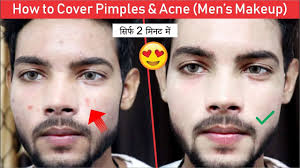 how to cover hide pimples acne men