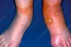 blisters in contact dermais due to