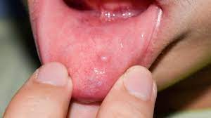 p inside lip symptom causes