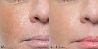 microneedling before and after gallery
