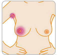 Pada peringkat ini, barah payudara sudah melibatkan nodus limfa ketiak, kulit ataupun otot yang. 10 Tanda Tanda Anda Menghidap Kanser Payudara Iluminasi