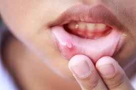 recurring canker sores are a symptom