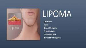 lipoma hibernoma ubiquitous