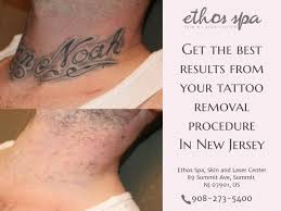 Your skin color might make removal difficult skin with the most contrast between it and the tattoo will usually have the best results. What Is The Hardest Color Tattoo To Remove