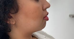 i got chin filler this is what i look