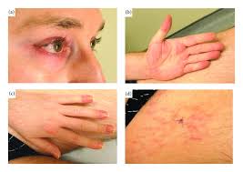 Palmar erythema is a rare condition that makes the palms of the hands turn red. Figure 1 Diffuse Muscular Pain Skin Tightening And Nodular Regenerative Hyperplasia Revealing Paraneoplastic Amyopathic Dermatomyositis Due To Testicular Cancer