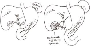 laparoscopic cholecystectomy removal