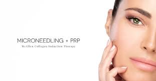 microneedling with prp perfect skin