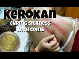 Padahal kerokan pun sebenarnya tidak diakui dalam dunia medis. Kerokan Indonesian Traditional Cure For Sickness Youtube