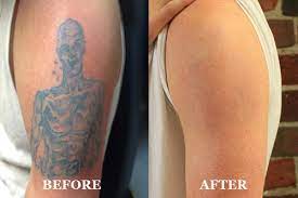 laser tattoo removal expert