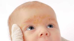 baby acne causes symptoms and treatment