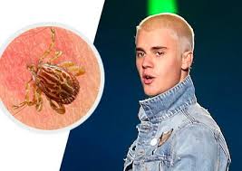 Resultado de imagen para Justin Bieber padece enfermedad de Lyme