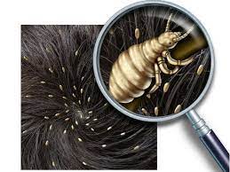 remes for head lice
