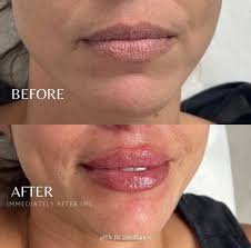 lips hydration before after results