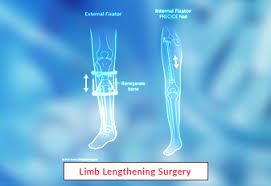 limb lengthening surgery procedure