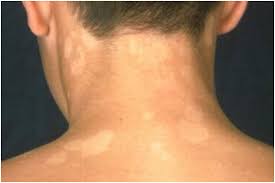 all about tinea versicolor causes