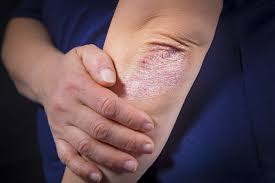 Resultado de imagen para imagenes de dermatitis en codos de humanos