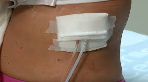 How To Care For A Post Surgery Wound Drainage System And Gauze Dressing
