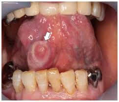 anterior lingual salivary gland