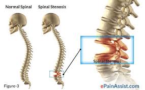 about spinal stenosis