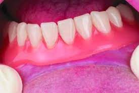 Denture repairs can help keep your dentures strong and comfortable. Dentures Lawsuits Denture Injury Poor Fitting Health Woes