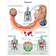 Cancer Medical Posters Cancer Anatomy Charts 3b Scientific