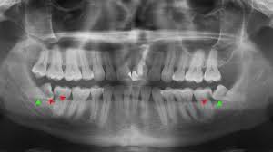 impacted wisdom tooth treatment