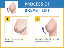 Breast Lift Surgery In Indore Sagging breasts of adequate size may be  lifted and made firmer to improve breast shape and reduce stretched areolas  without enlargement. This operation is often requested after