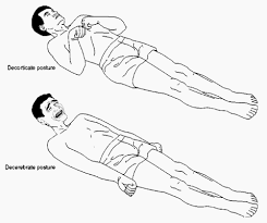 decerebrate posture vs decorticate